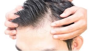 paciente con alopecia