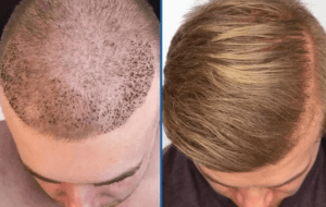 trasplante de cabello