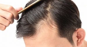 Cómo revertir la caída del cabello