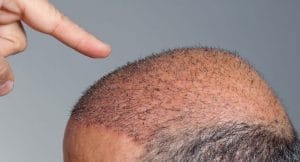 Razones para realizar un tratamiento de injerto de cabello
