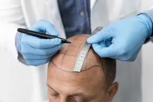 Injerto de cabello sin dolor