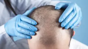 paciente con caída de cabello-alopecia androgénica