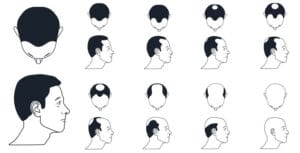 Escala de alopecia masculina Hamilton-Norwood