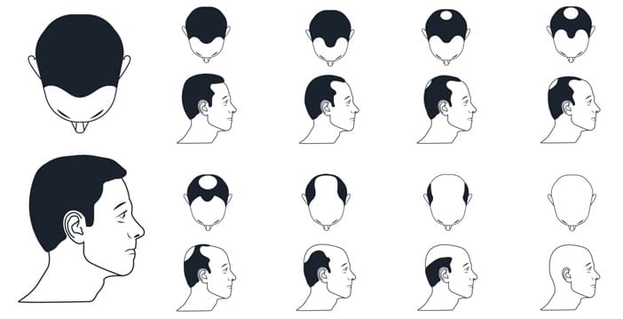 Escala de alopecia masculina Hamilton-Norwood