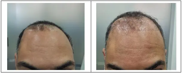 injerto capilar en paciente con craniectomía y craneoplastia