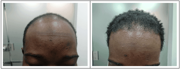 paciente con cabello ulótrico