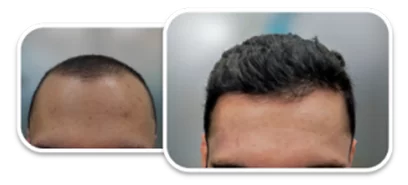 testimonio implante capilar después de la caída de cabello o hair loss - ileanovo