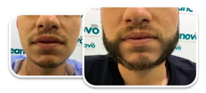 mejora de imagen con injerto de barba - ileanovo