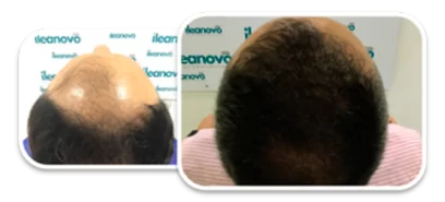 recuperación de cabellera después de la pérdida de cabello o hair loss - ileanovo