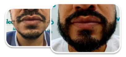testimonio injerto de barba - ileanovo
