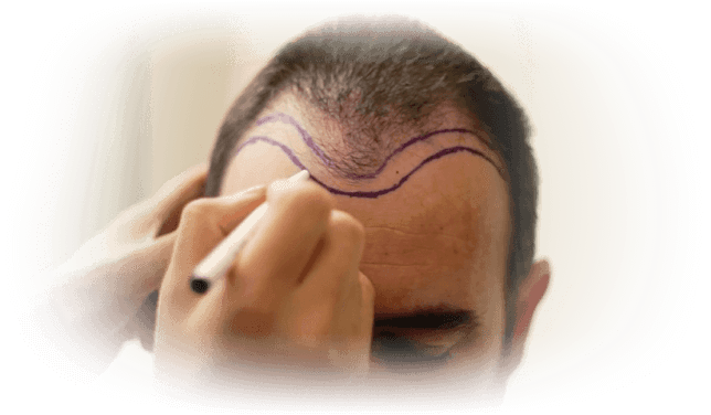 hair loss patient - ileanovo perú