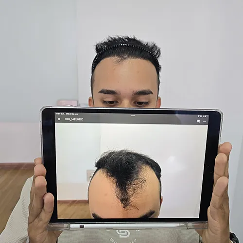 testimonio-injerto-14