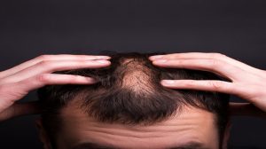 Injerto Capilar - caída del cabello