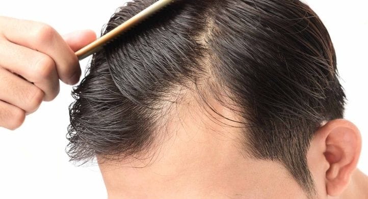 Cómo revertir la caída del cabello