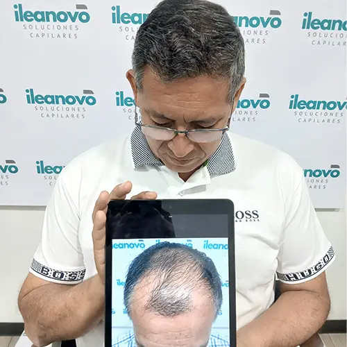 img-injerto1